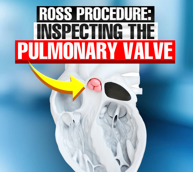 ROSS PROCEDURE Q&A: