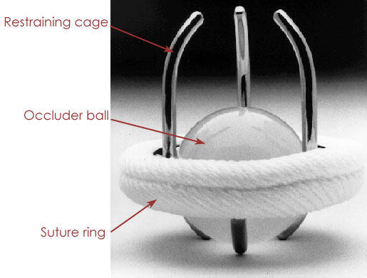 Caged Ball Mechanical Valve Replacement