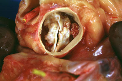 Calcified Heart Valve Leaflets