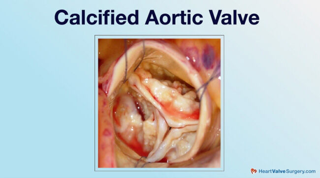 Calcified Aortic Valve Leaflets
