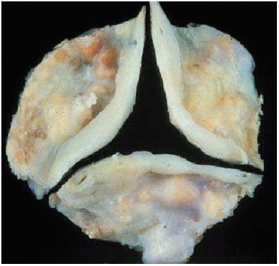 Calcified Aortic Valve Leaflets With Three Cusps