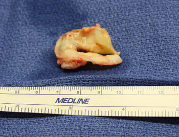 Calcified Aortic Bicuspid Valve From Patient