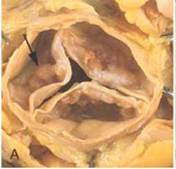 Calcified Leaflets Aortic Valve