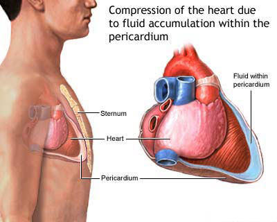 Drawing Of Compressed Heart Due To Fluid Build-Up