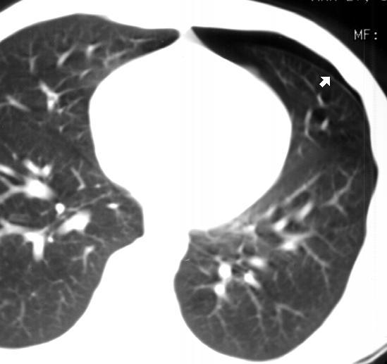 Cat Scan Aorta Image