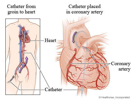 Cardiac Catheterization Before Heart Surgery