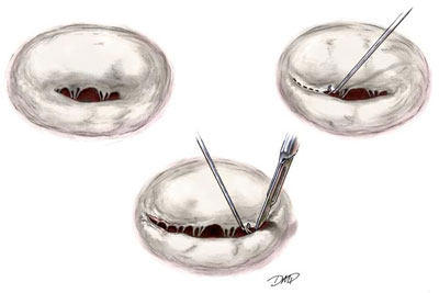 Commissurotomy Diagram For Mitral Valve Repair