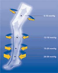 Compression Stockings After Heart Surgery