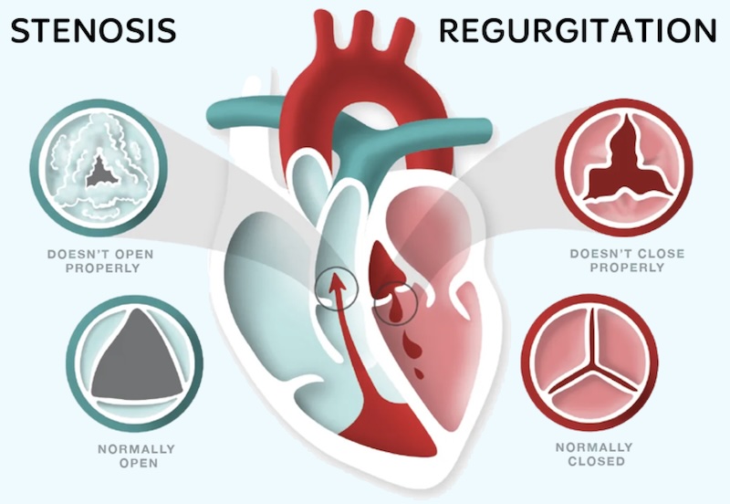 Diagram comparing heart valve stenosis (narrow opening) and regurgitation (leaky valve)