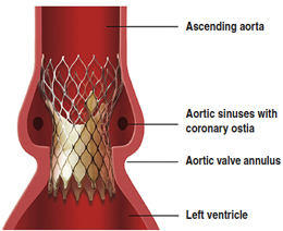 Implant Diagram Of The CoreValve TAVI Device