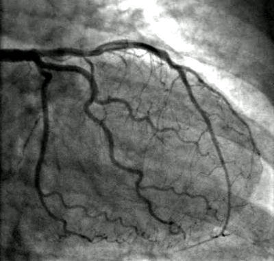 Angiogram Risks: Potential Angiography Dangers Angiogram Risks: Potential Angiography Dangers