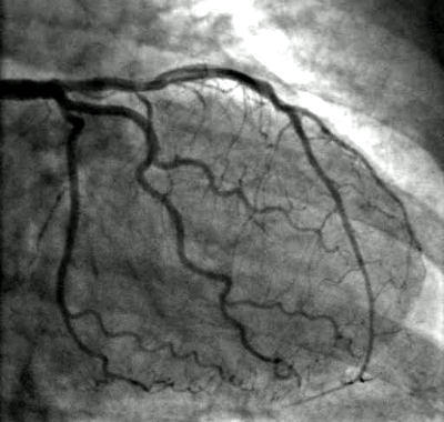 Cardiac Catheterization (Angiogram)