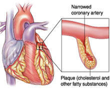 Coronary Artery Disease