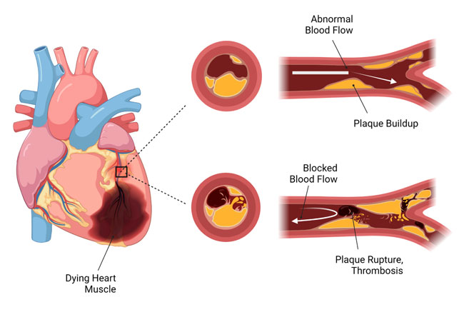 Coronary Artery Disease