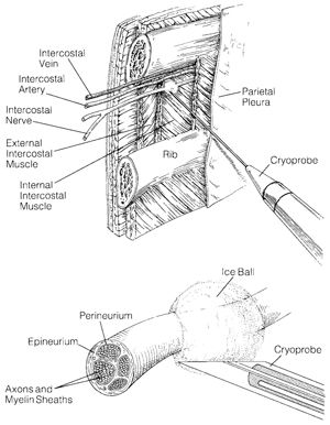 Cryoanalgesia Incision