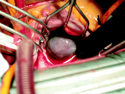 Cyst In Mitral Heart Valve