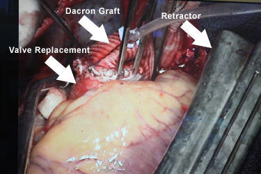 Dacron Graft - Aortic Root Replacement with Aortic Valve Replacement