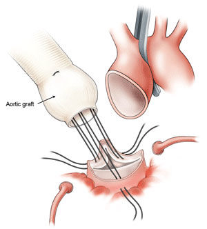 David Procedure Surgery Diagram