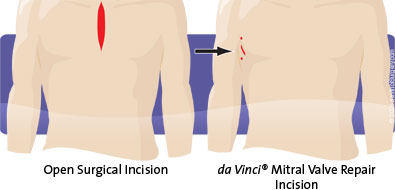 Open Heart Scar Compared to Robotic Surgery Scar