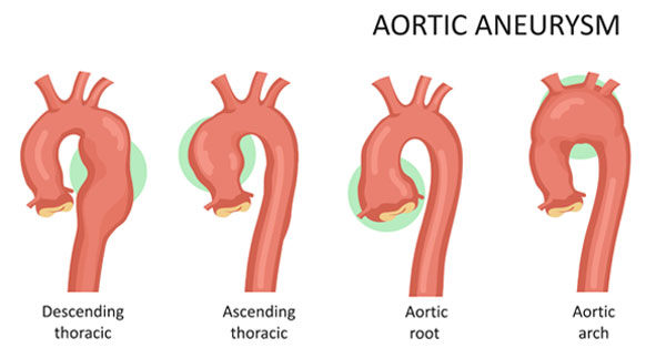 Diagram Of Ascending Aorta