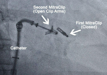 Double MitraClip Placement Under X-Ray