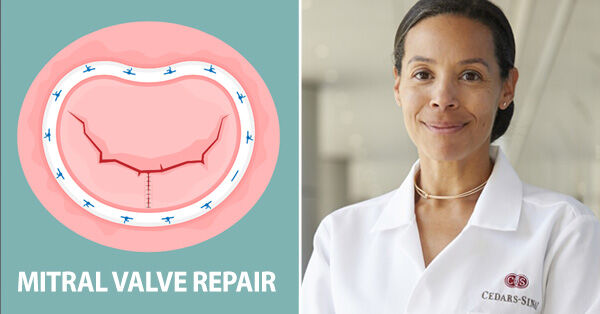 Mitral Valve Repair with Dr. Joanna Chikwe