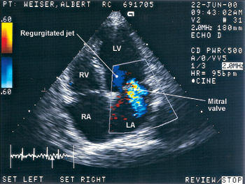 Echocardiogram Image