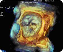 Mitral Valve Echocardiogram