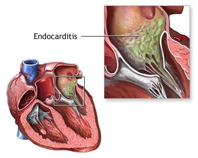 Bacterial Endocarditis - Heart Valve Infection Disease