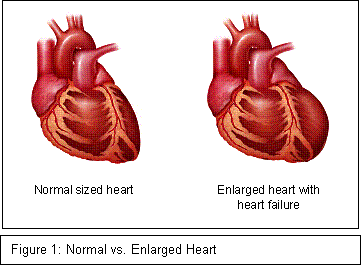 Normal And Enlarged Heart Comparison