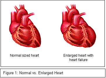 Normal And Enlarged Heart Comparison