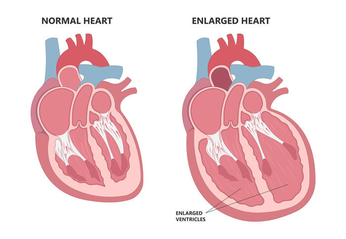 Enlarged Heart Compared to Normal Heart with Ventricles