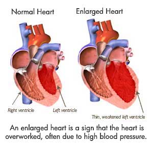 Normal & Enlarged Heart Comparison