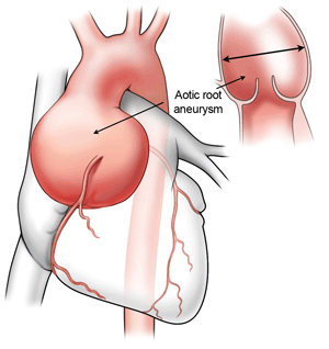 Enlarged Aorta After Bicuspid Aortic Valve Surgery