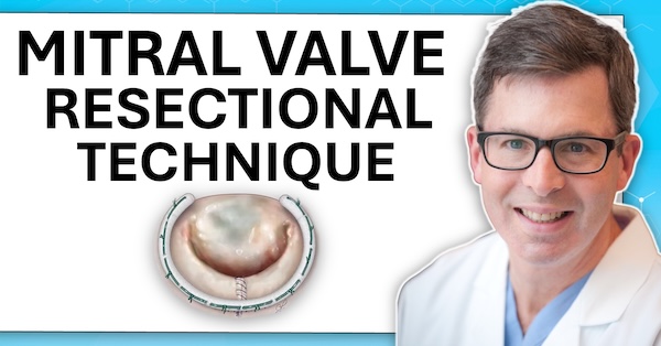 Ask Dr. Gillinov: The Mitral Valve Resectional Technique