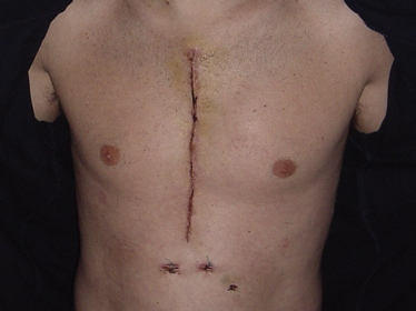 Glued Incision After Heart Surgery