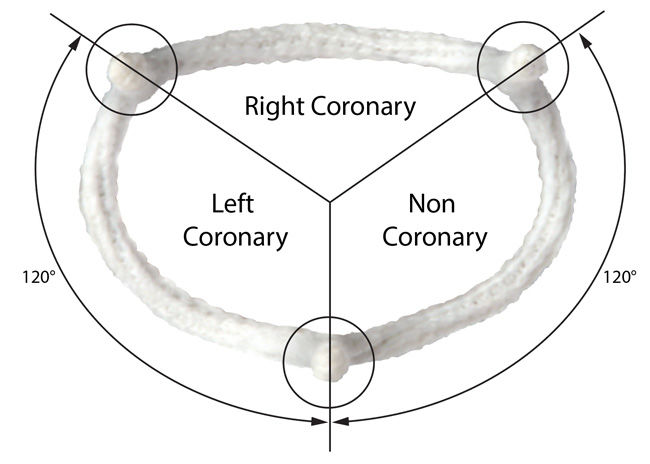 Aortic Valve Repair Ring