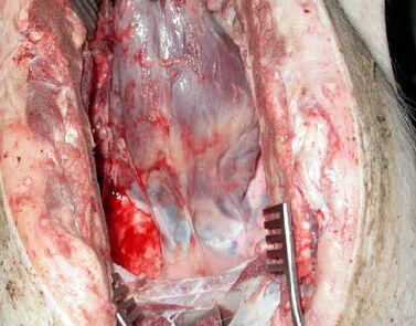 Heart adhesions on sternum