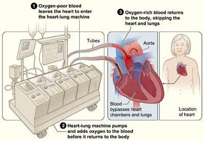 Diagram Of The Heart Lung Machine