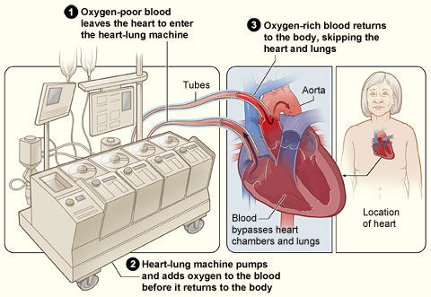 5 Facts About The Heart Lung Machine For Patients 5 Facts About The Heart Lung Machine For Patients