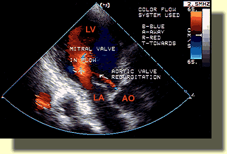 Echocardiogram Of The Heart