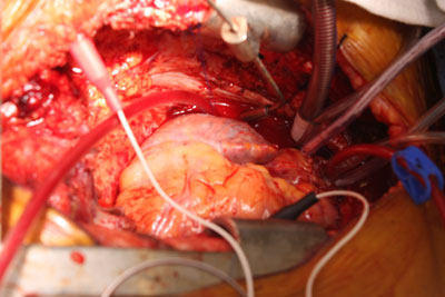 Transplanted Heart Beats For The First Time