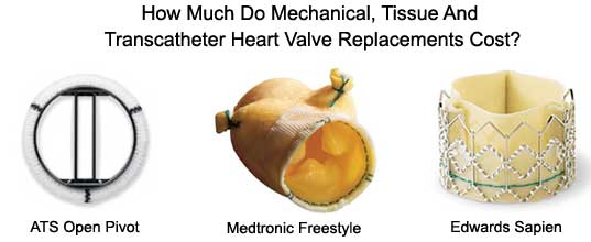 Costs of Heart Valve Replacements - Mechanical, Tissue, Bioprosthetic, Homografts