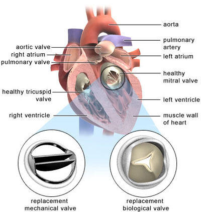 Mitral Valve Replacement Positioning Diagram