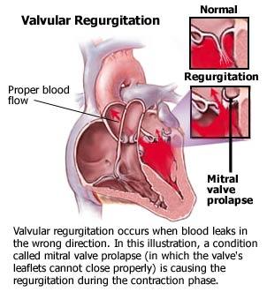 Leaking Heart Valve