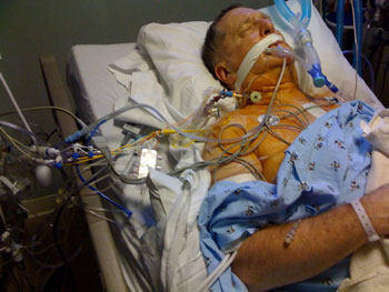 Patient In ICU Connected To Multip Tubes