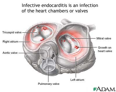 Bacterial Endocarditis Diagram