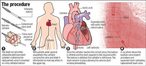 Keyhole Surgery Images