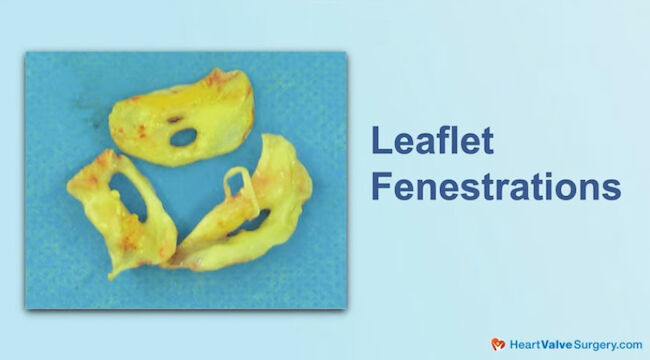 Heart Valve Leaflet Fenestrations