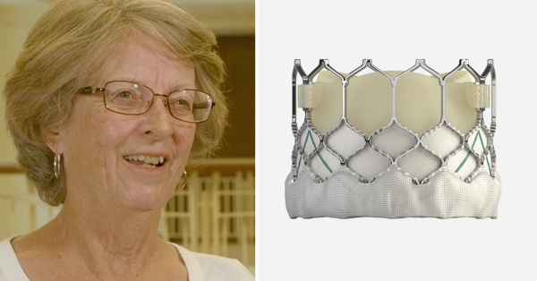 Jean Frank, transcatheter aortic valve replacement patient
